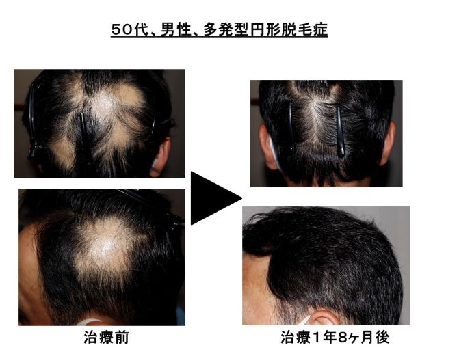 円形脱毛症　病院